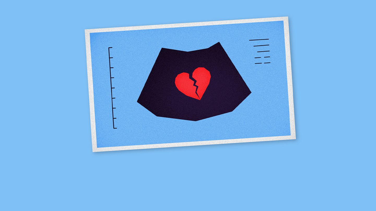 Fausses couches : la fin d'un tabou ?