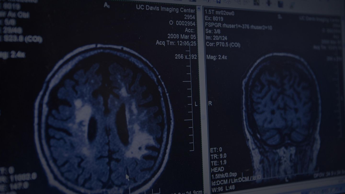 Alzheimer