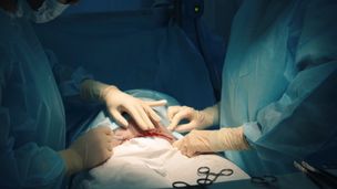 Est-il vrai que César est né par césarienne ?